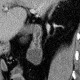 Crohn's disease of duodenum: CT - Computed tomography