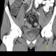 Crohn's disease of neoterminal ileum, abscess: CT - Computed tomography
