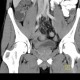 Crohn's disease of neoterminal ileum, abscess: CT - Computed tomography