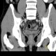 Crohn's disease of neoterminal ileum, abscess: CT - Computed tomography