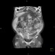 CT peritoneography, VRT: CT - Computed tomography