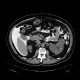 CT peritoneography: CT - Computed tomography