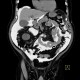 CT peritoneography: CT - Computed tomography
