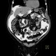 CT peritoneography: CT - Computed tomography