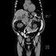 CT peritoneography: CT - Computed tomography