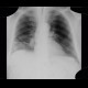 CT angiogram sign, acute lung embolism, lung infarction: X-ray - Plain radiograph