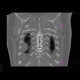 CT angiogram sign, acute lung embolism, lung infarction: CT - Computed tomography