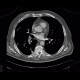 CT angiogram sign, acute lung embolism, lung infarction: CT - Computed tomography