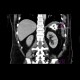 CT fistulography, enterocutaneous fistula: CT - Computed tomography
