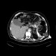 CT fistulography, enterocutaneous fistula: CT - Computed tomography