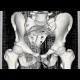 Fracture of pubic bone and sacrum, SSD: CT - Computed tomography