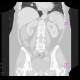 Lung carcinoma, accidental finding on enterography: CT - Computed tomography