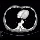 Chondrohamartoma, accidental finding on enterography: CT - Computed tomography