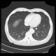 Chondrohamartoma, accidental finding on enterography: CT - Computed tomography