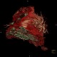 CTEPH, chronic thromboembolic pulmonary arterial hypertension, VRT: CT - Computed tomography