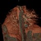 CTEPH, chronic thromboembolic pulmonary arterial hypertension, VRT: CT - Computed tomography