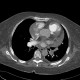 CTEPH, chronic thromboembolic pulmonary arterial hypertension: CT - Computed tomography