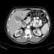 Cystic nephroma, Perlmann's tumour: CT - Computed tomography