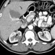 Cystic nephroma, Perlmann's tumour: CT - Computed tomography
