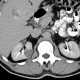 Cystic nephroma, Perlmann's tumour: CT - Computed tomography