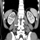 Cystic nephroma, Perlmann's tumour: CT - Computed tomography