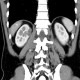 Cystic nephroma, Perlmann's tumour: CT - Computed tomography
