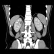 Cystic nephroma, Perlmann's tumour: CT - Computed tomography