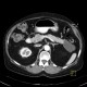Cystic tumour of pancreas, pancreatic tail: CT - Computed tomography