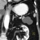 Cystic tumour of pancreas, pancreatic tail: CT - Computed tomography