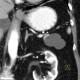 Cystic tumour of pancreas, pancreatic tail: CT - Computed tomography