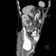 Renal carcinoma, cystic, retroperitoneal lymphadenopathy: CT - Computed tomography