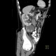 Renal carcinoma, cystic, retroperitoneal lymphadenopathy: CT - Computed tomography