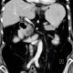 Serous cystadenoma of pancreas, cystadenoma, cystic tumour: CT - Computed tomography