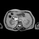 Serous cystadenoma of pancreas, cystadenoma, cystic tumour: MRI - Magnetic Resonance Imaging