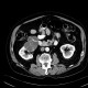 Cystadenoma of the kidney, Perlmann's tumour: CT - Computed tomography