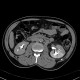 Pyelocystitis, narrowing of calyceal neck: CT - Computed tomography