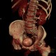 Pyelocystitis, narrowing of calyceal neck: CT - Computed tomography