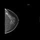 Breast carcinoma: MMG - Mammography