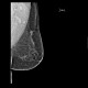 Breast carcinoma: MMG - Mammography