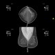 Breast carcinoma: MMG - Mammography