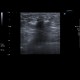 Breast carcinoma, ultrasound guided biopsy: US - Ultrasound