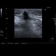 Breast carcinoma: US - Ultrasound