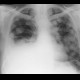 Metastatic disease of lung, cannon ball metastases: X-ray - Plain radiograph