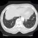 Carcinomatous lymphangoitis, lymphangoitis carcinosa, osteolysis of shoulder blade: CT - Computed tomography