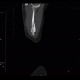 Carcinomatous lymphangoitis, lymphangoitis carcinosa, osteolysis of shoulder blade: CT - Computed tomography