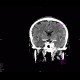 Cavum septi pellucidi: CT - Computed tomography