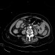 IPMN, intrapapillary mucinous neoplasm, central type, colitis: CT - Computed tomography