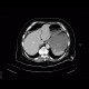 Ileus, bowel ischemia: CT - Computed tomography