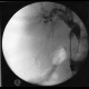 Cholangoitis, acute, perioperative cholangiography: RF - Fluoroscopy