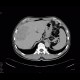Cholangiocellular carcinoma: CT - Computed tomography